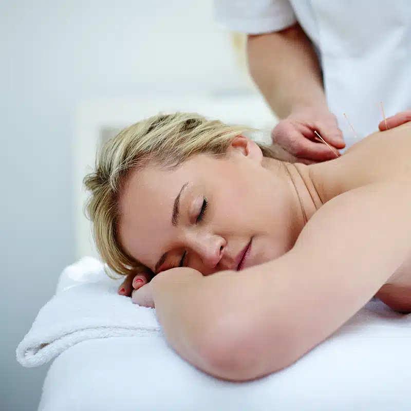Caucasian woman receiving an acupuncture treatment